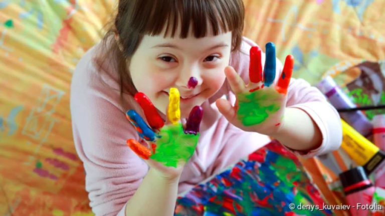 Down syndrome (trisomy 21): symptoms, consequences, cause