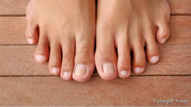Nail fungus: What helps, how to recognize it?