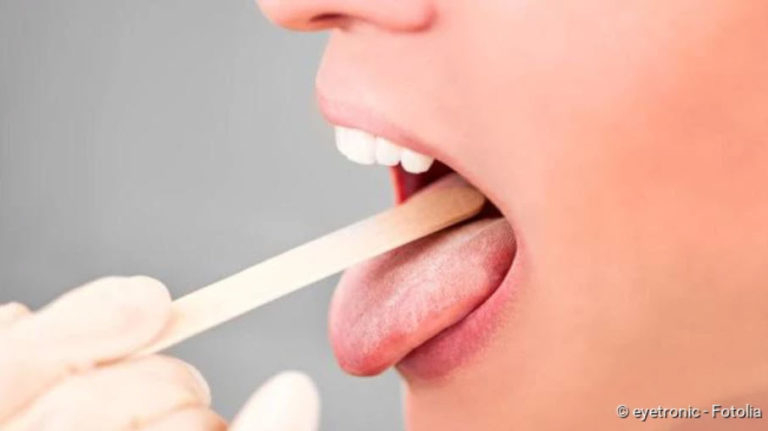 Tonsil stones: causes, signs, removal