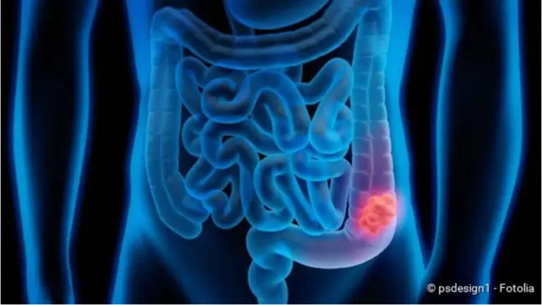 Colon cancer: symptoms, warning signs, therapy, prognosis