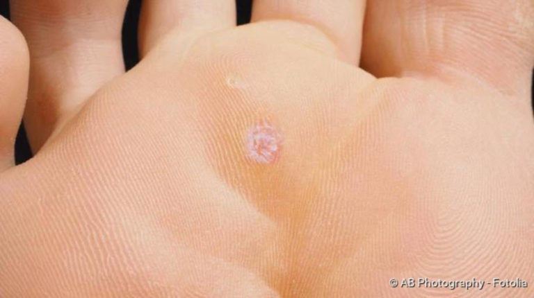 Plantar warts: Recognizing and treating warts on the foot