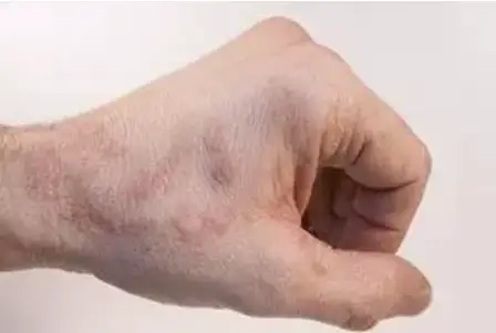 Neurodermatitis on the hands: What helps?