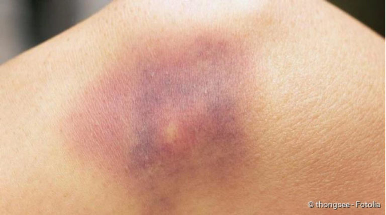 Bruising: symptoms, therapy, duration of healing