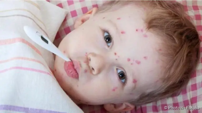 Chickenpox: Infection, protection, symptoms