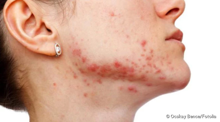 Shingles in the face: causes, course, prognosis