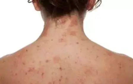Neurodermatitis Of The Body And Atopic Eczema