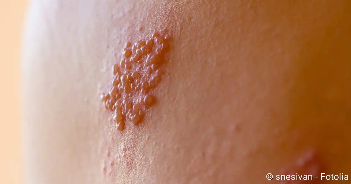 shingles (herpes zoster)
