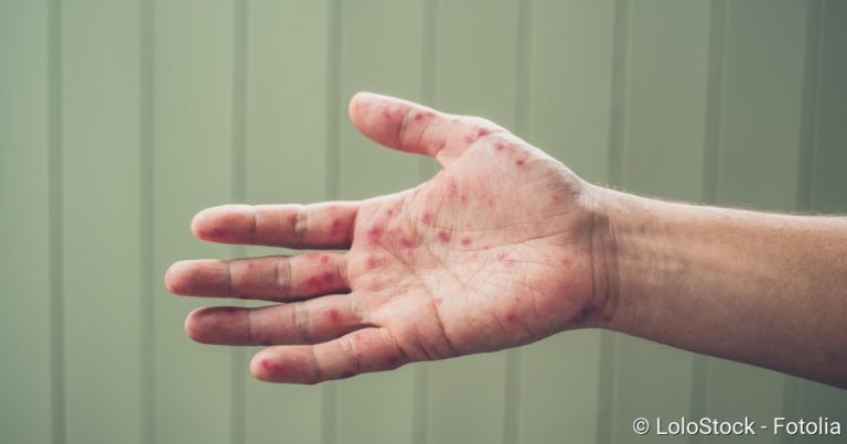 Hand-foot-and-mouth disease: infection, symptoms, treatment