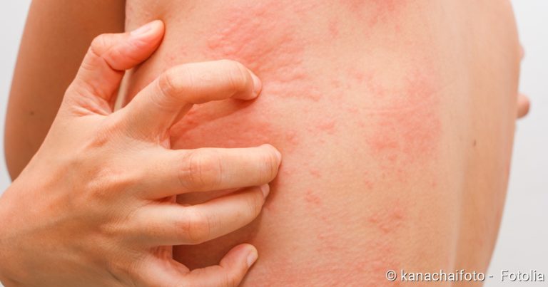 Hives (Urticaria): Symptoms, Causes, Diagnosis, And Treatment