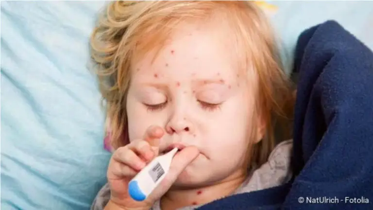Measles: Infection, Symptoms, Treatment