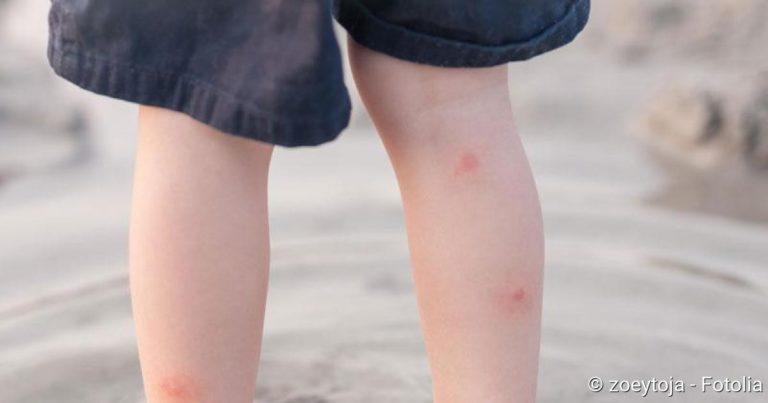 Insect bite swelling treatment: What To Do And When to see a doctor!